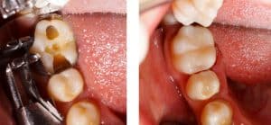 How Do Tooth Colored Fillings Work?