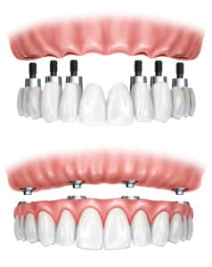 engelberg implant dentures